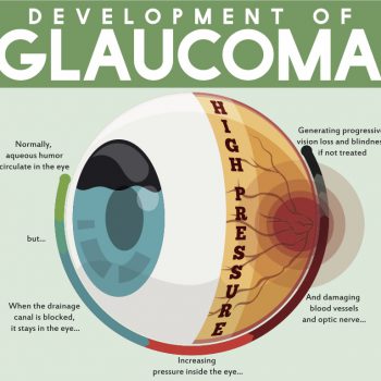 The development of Glaucoma