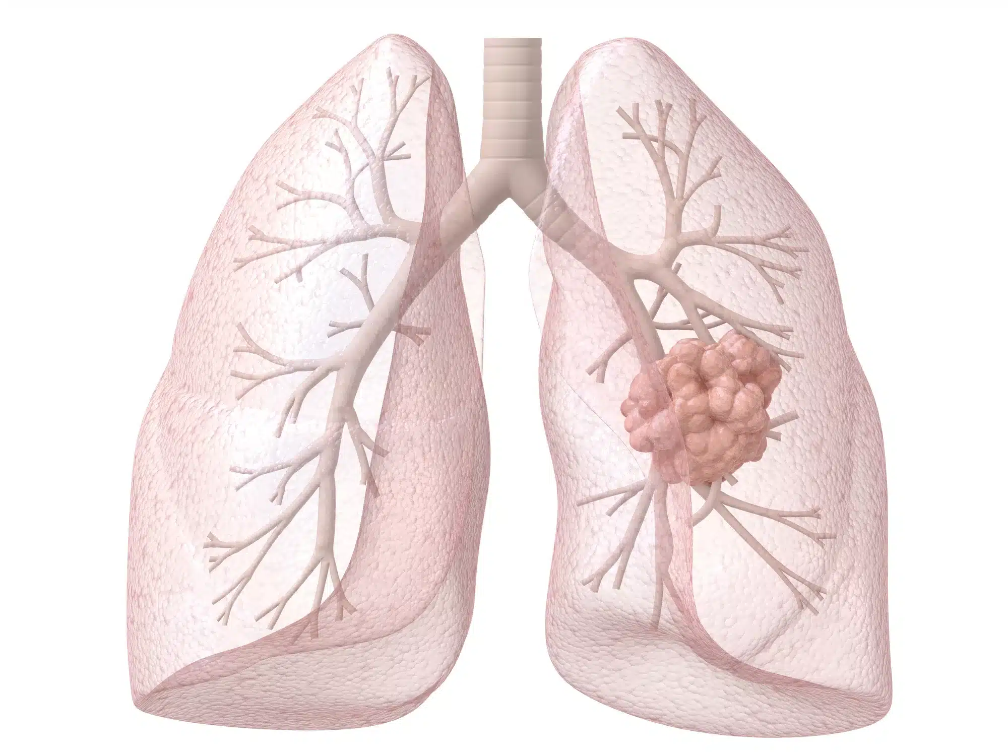 lung-cancer-is-more-common-in-non-smokers-than-you-think-ez-insure